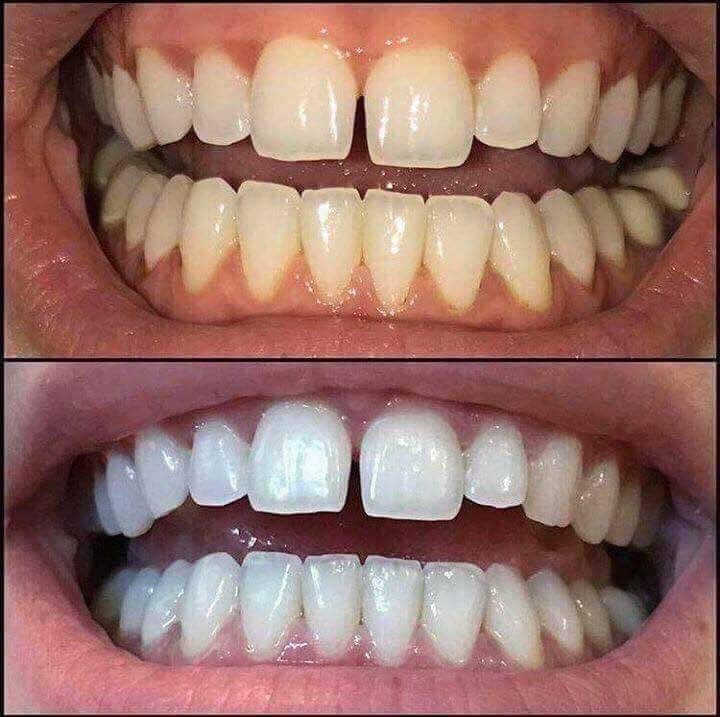 SmilePeopl Tandblekningspenna