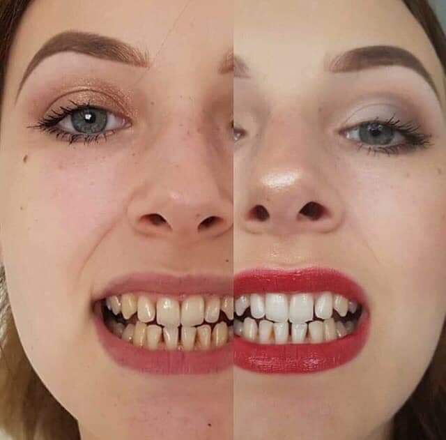 SmilePeopl Tandblekningspenna
